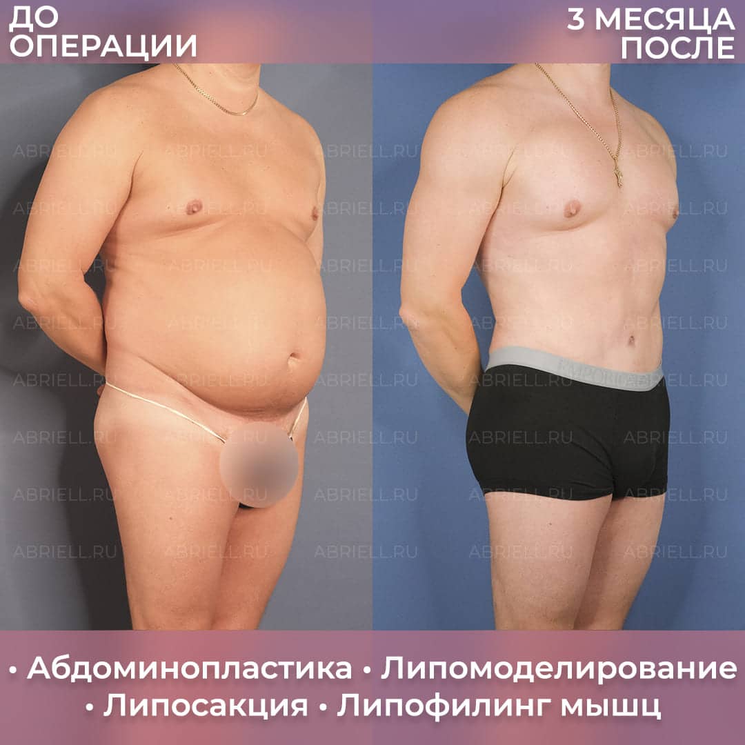 Абдоминопластика живота у Левицкой (Бурловой) М.Г