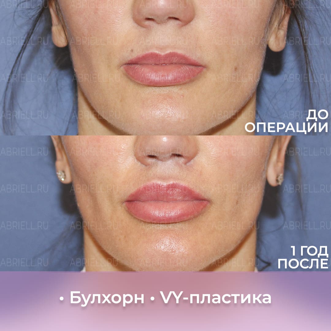 Хейлопластика губ у Кочневой И.С