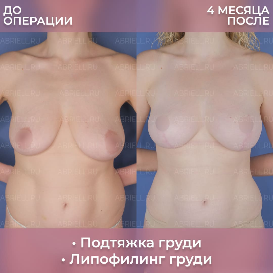 Лифтинг груди у Бурловой (Левицкой) М.Г