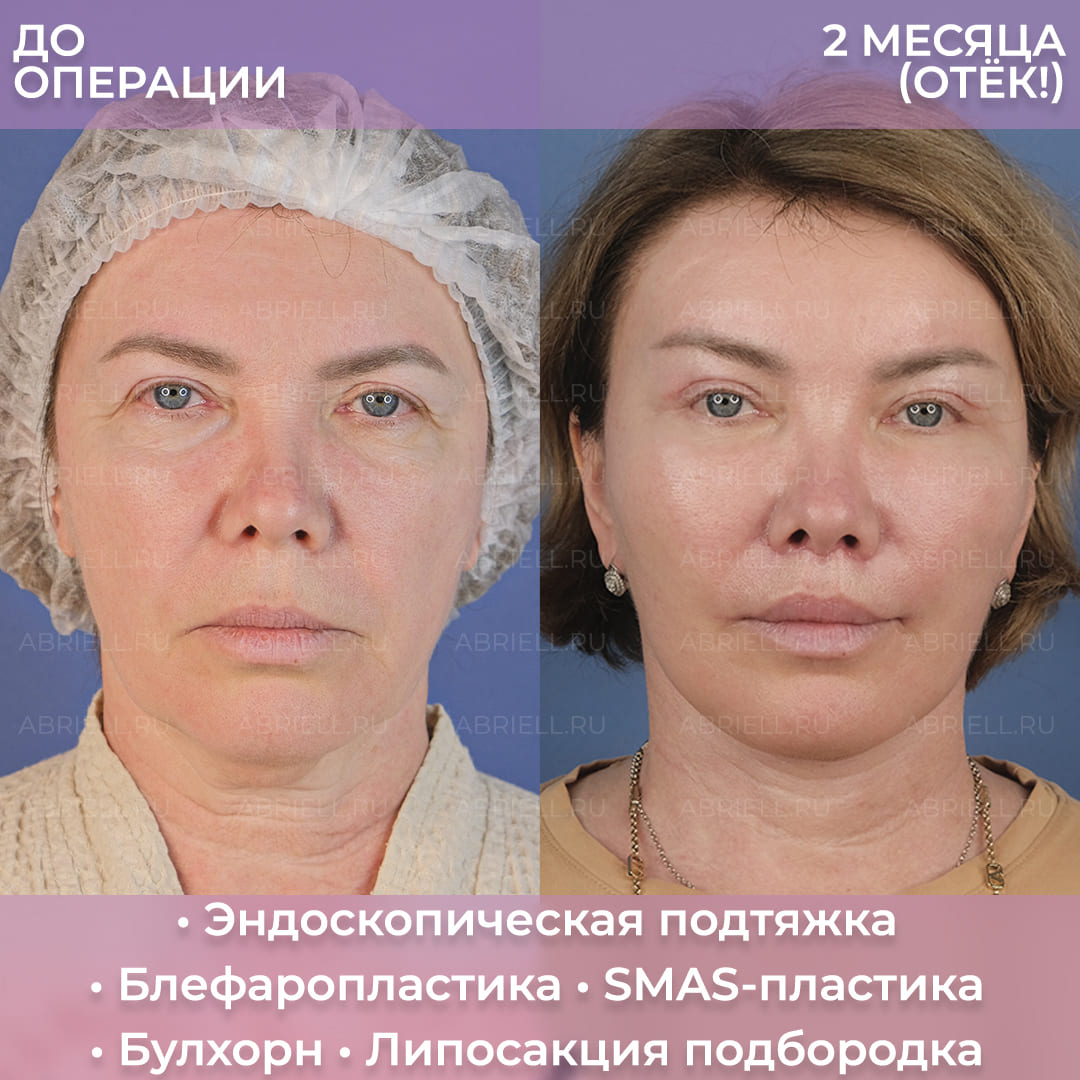 До и после подтяжки лица у Кочневой И.С
