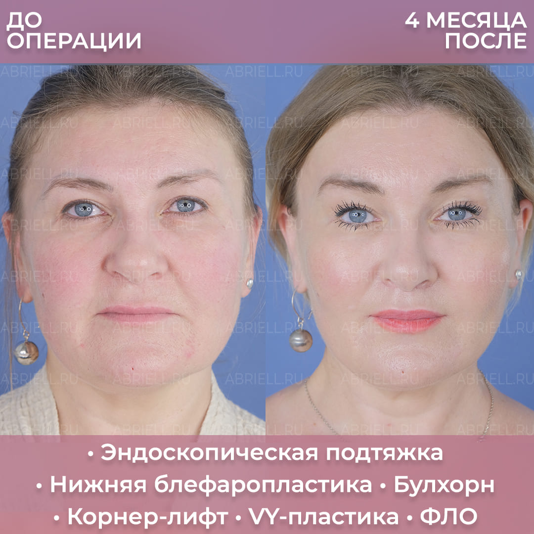 Результаты лифтинга лица у Бурловой (Левицкой) М.Г