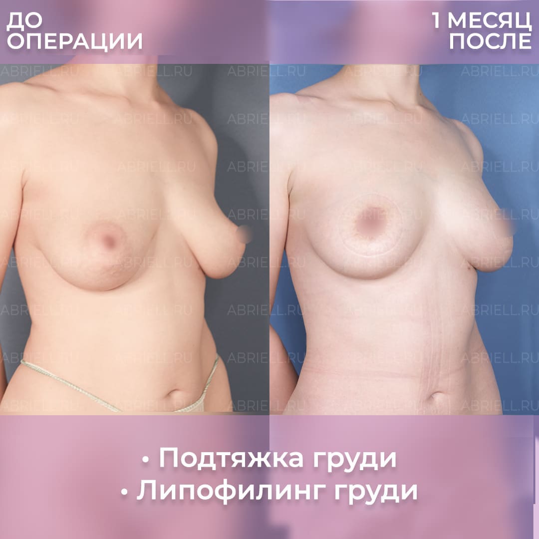 До и после увеличения груди у Кочневой И.С