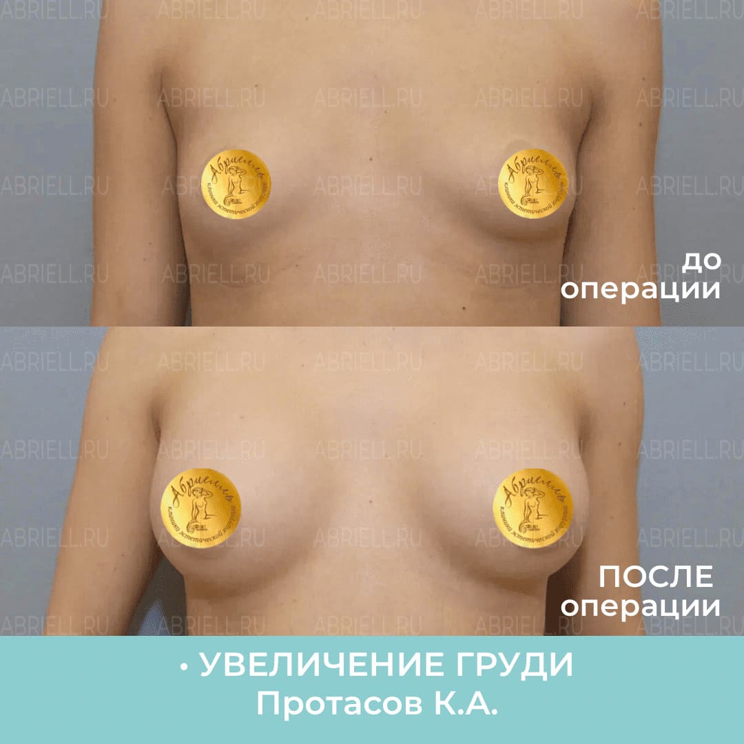 какой гормон отвечает за рост груди у женщин фото 109