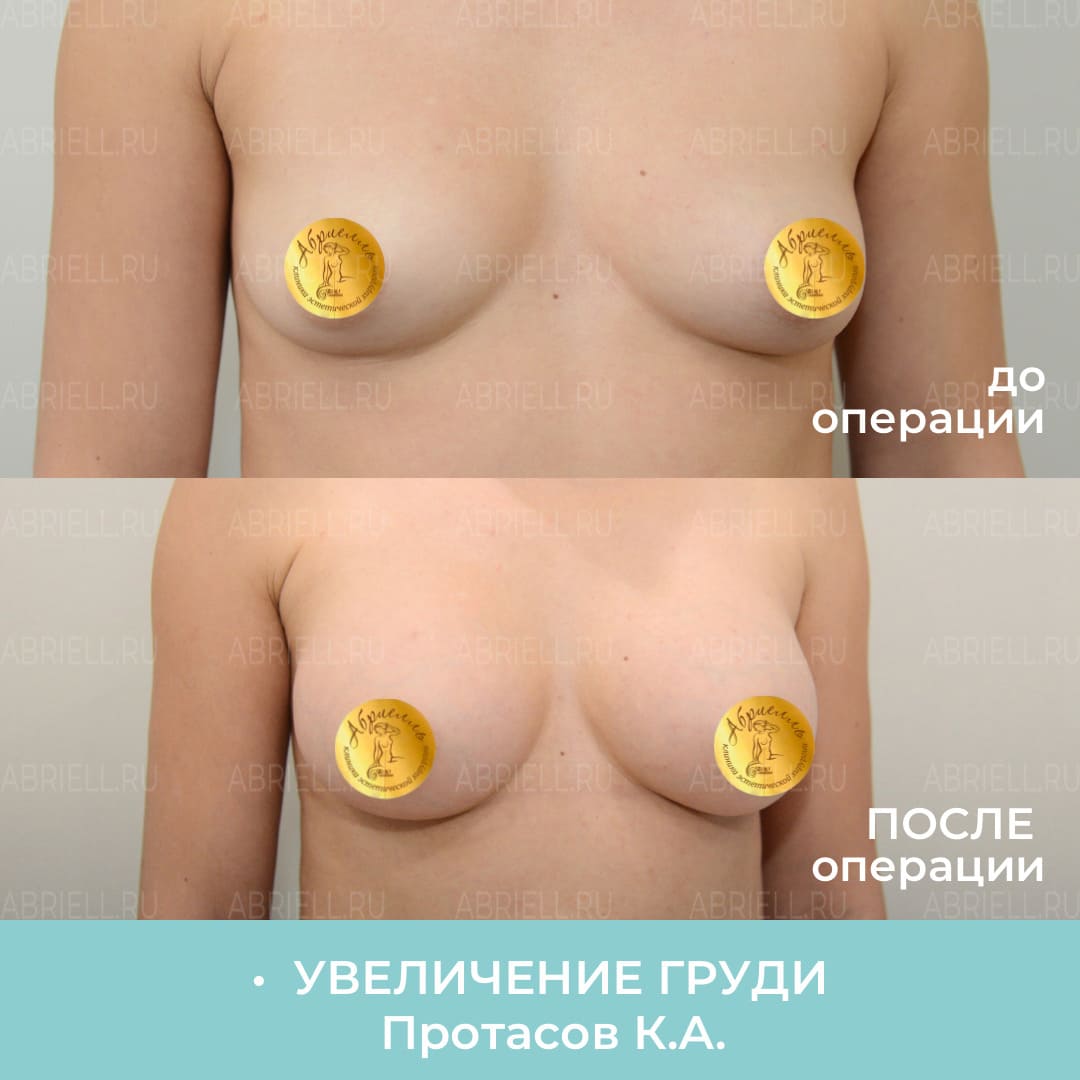 может ли при мастопатии увеличиться одна грудь фото 61