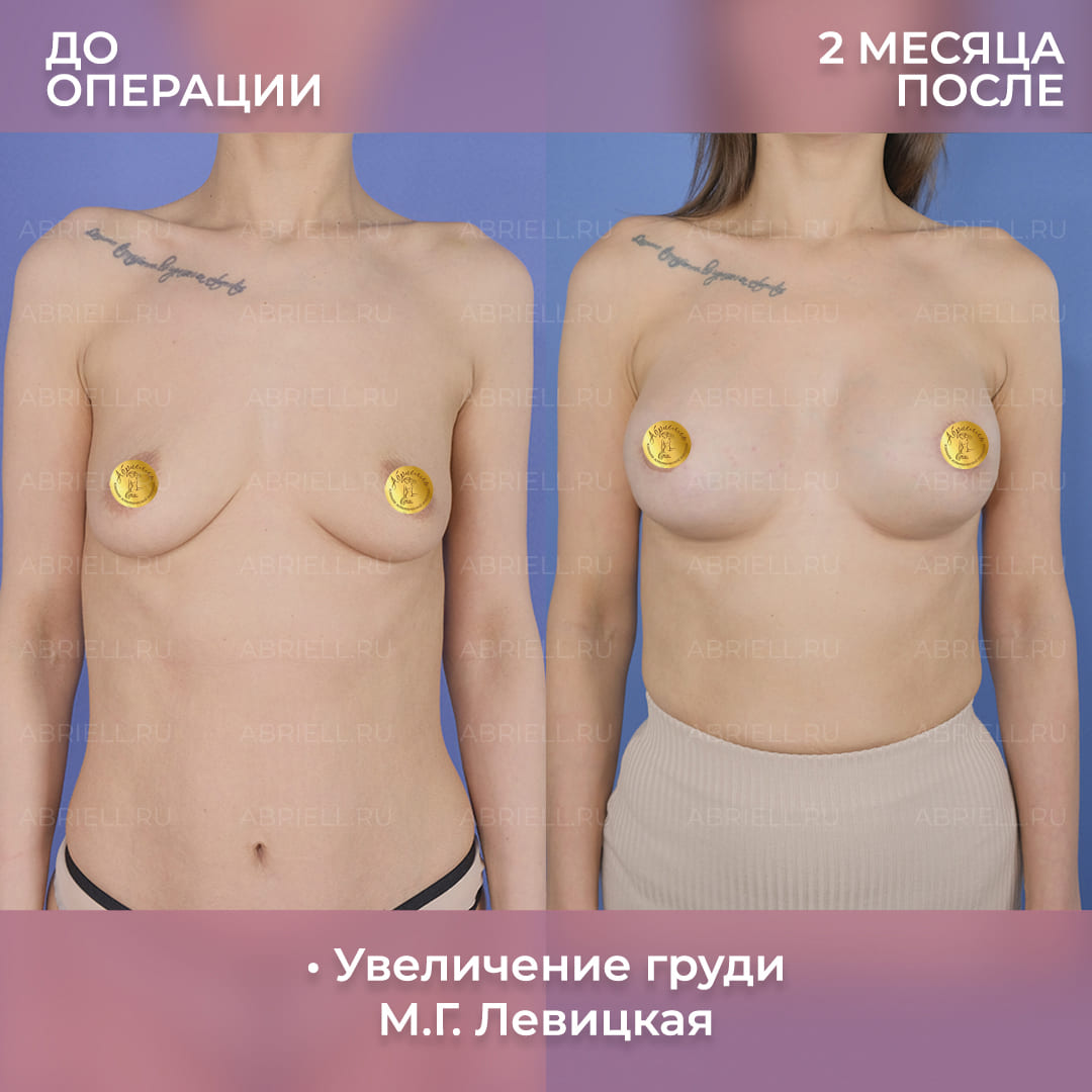 Пластическая операция на грудь у Бурловой (Левицкой) М.Г