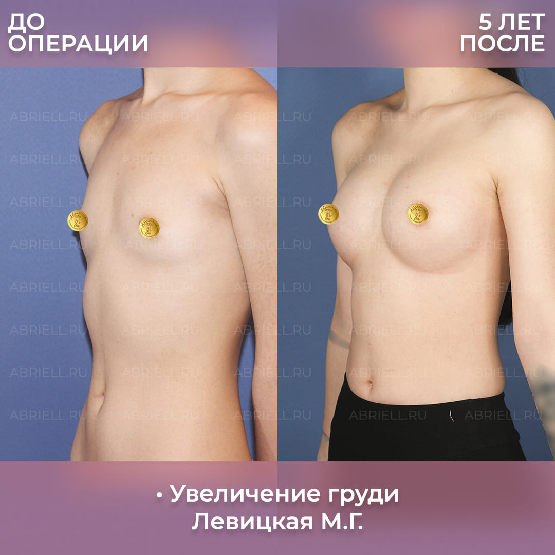 Увеличение груди у Бурловой (Левицкой) М.Г