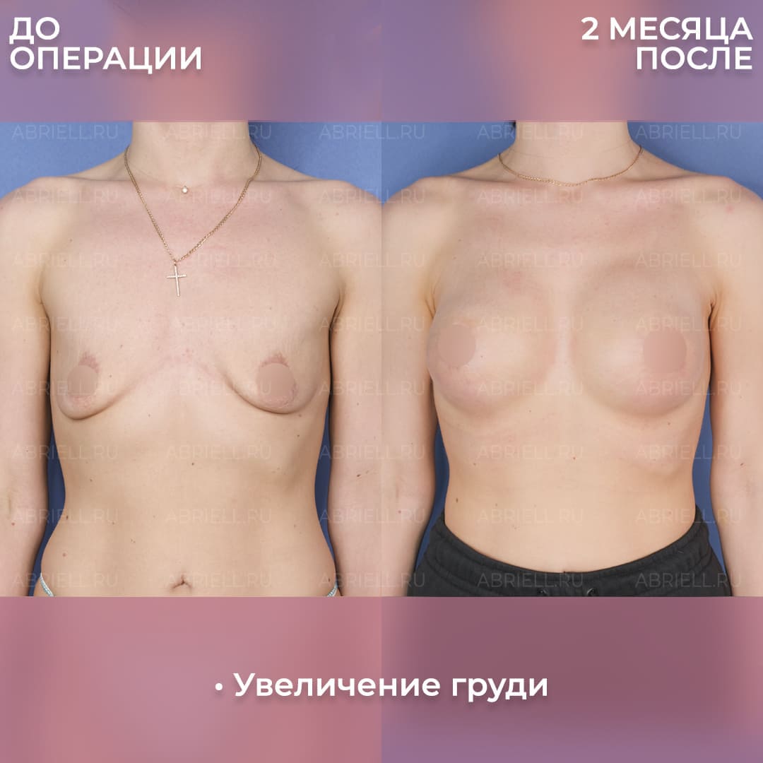 Пластика груди у Бурловой (Левицкой) М.Г