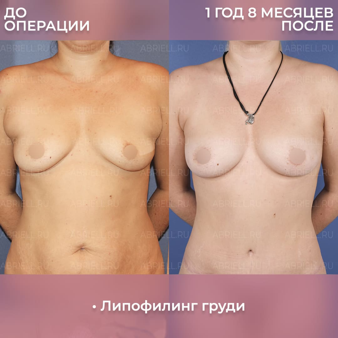 Увеличение груди у Бурловой (Левицкой) М.Г