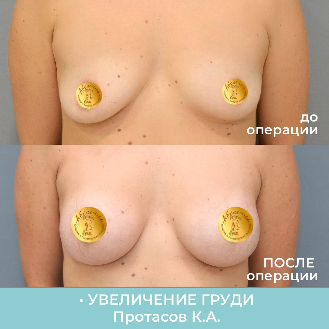 увеличивается грудь с возрастом у женщин фото 53