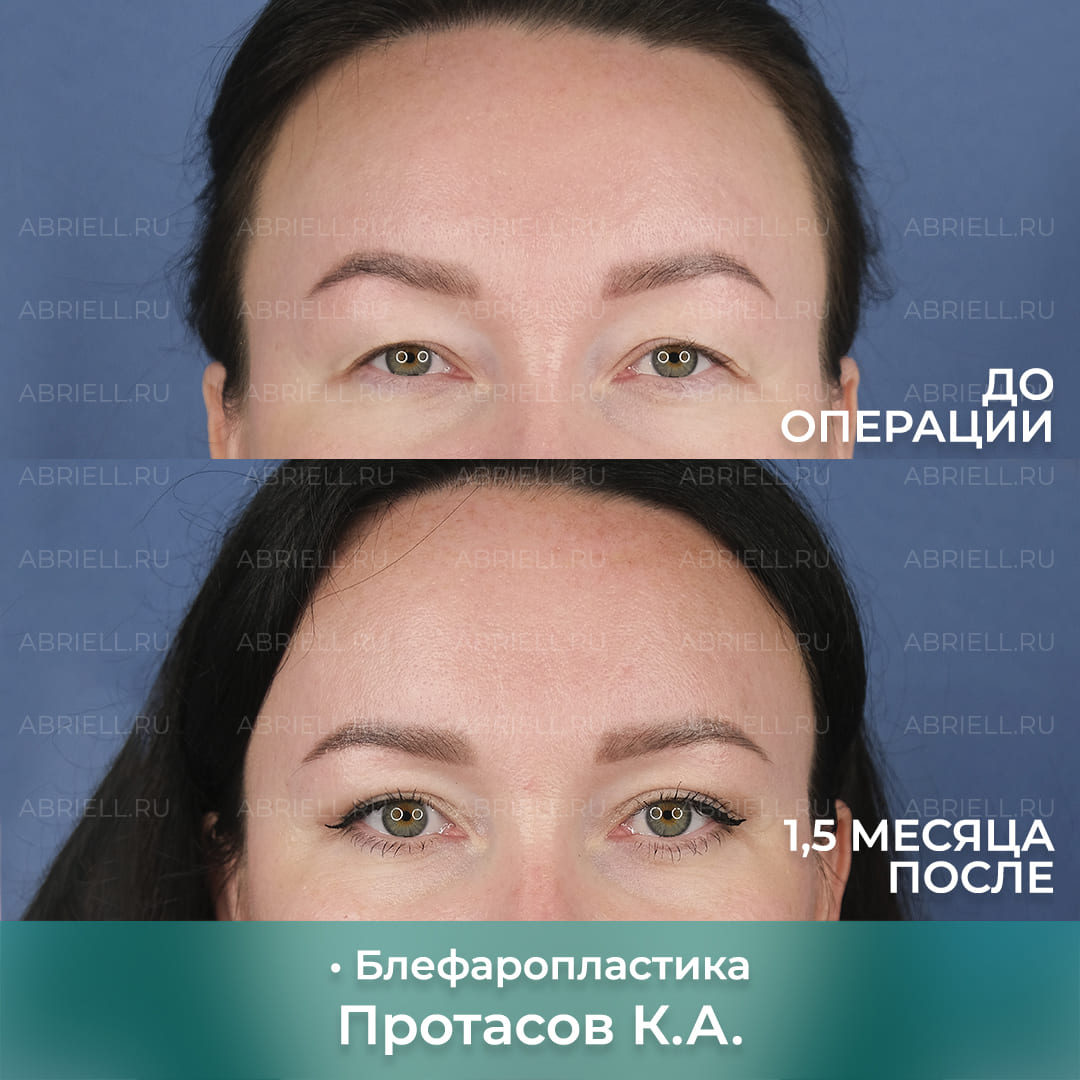 Блефаропластика у доктора Протасова