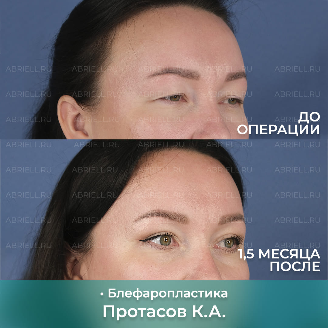 Блефаропластика у доктора Протасова