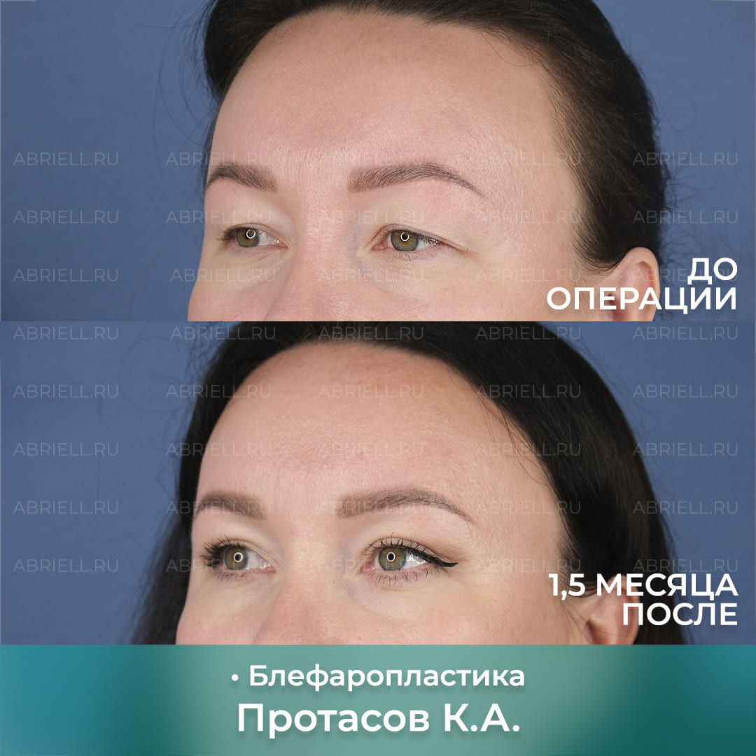 Блефаропластика у доктора Протасова