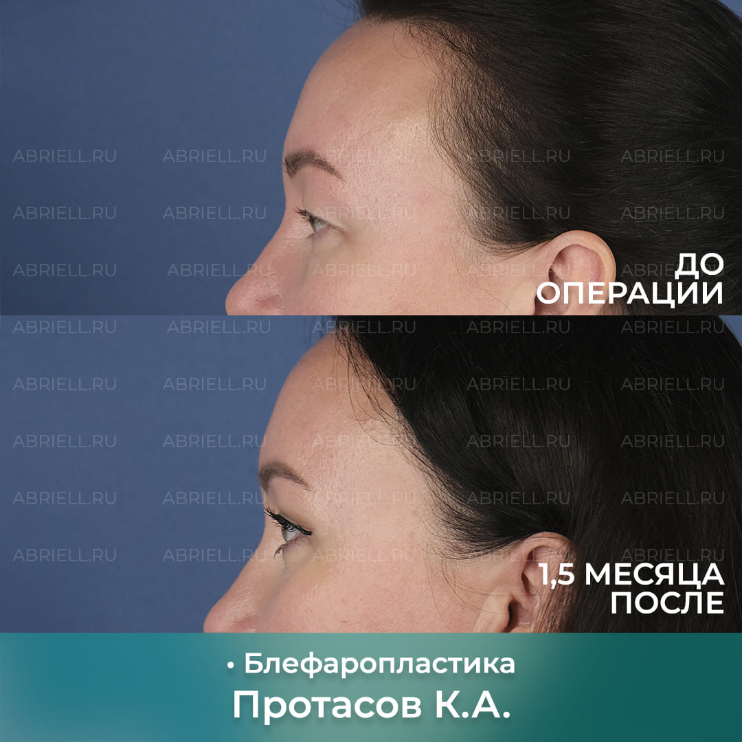 Блефаропластика у доктора Протасова