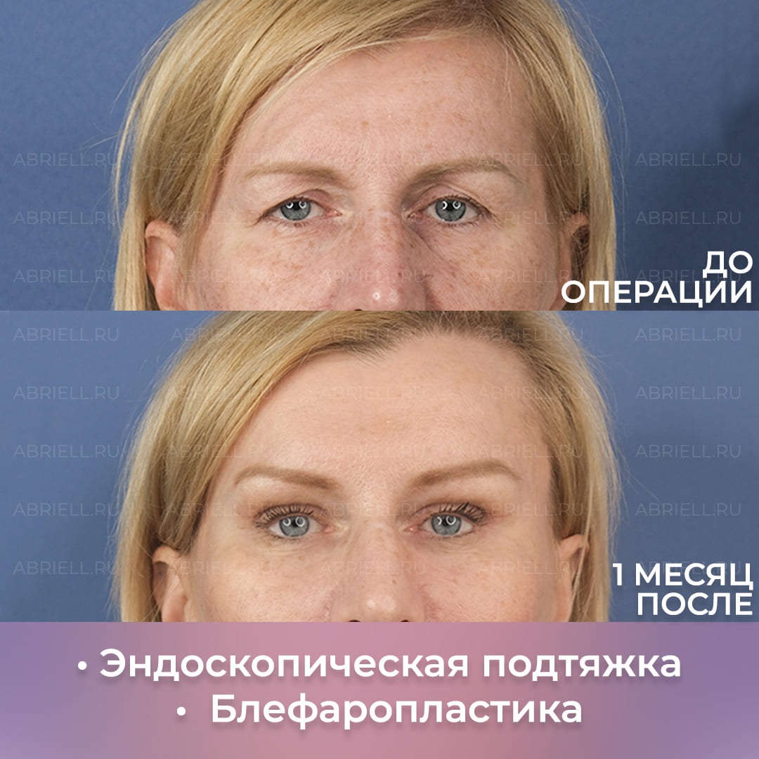 Результат пластической операции на лице