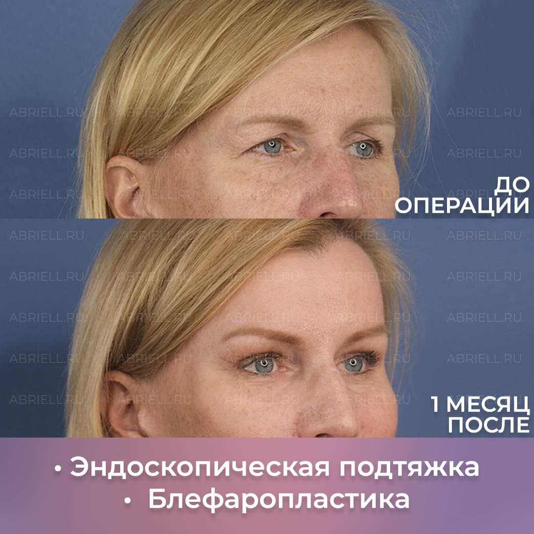 Пример пластической операции на лице