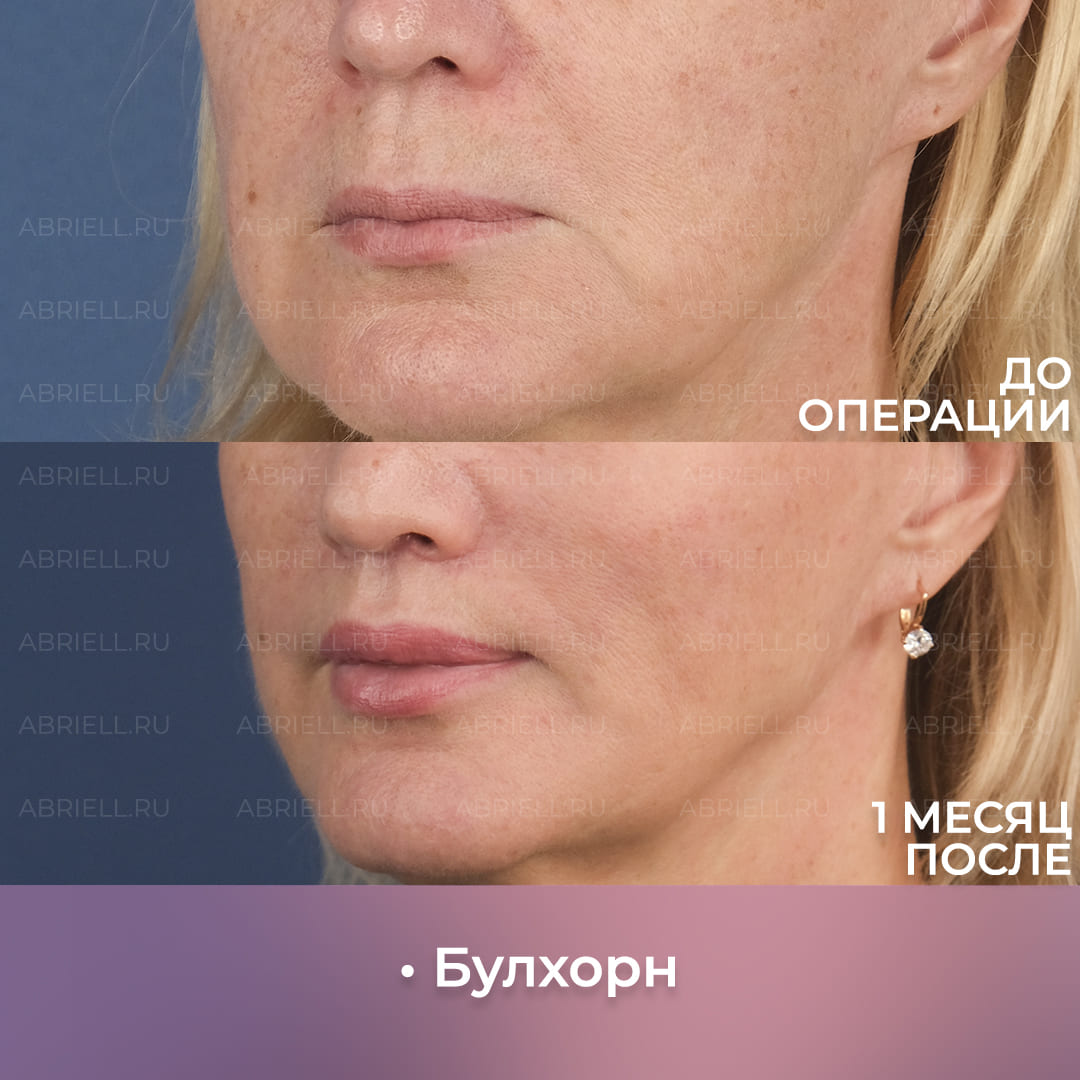 Фото результата пластической операции на лице