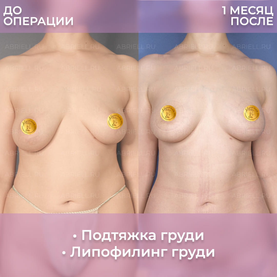 Результат подтяжки и увеличения груди жиром