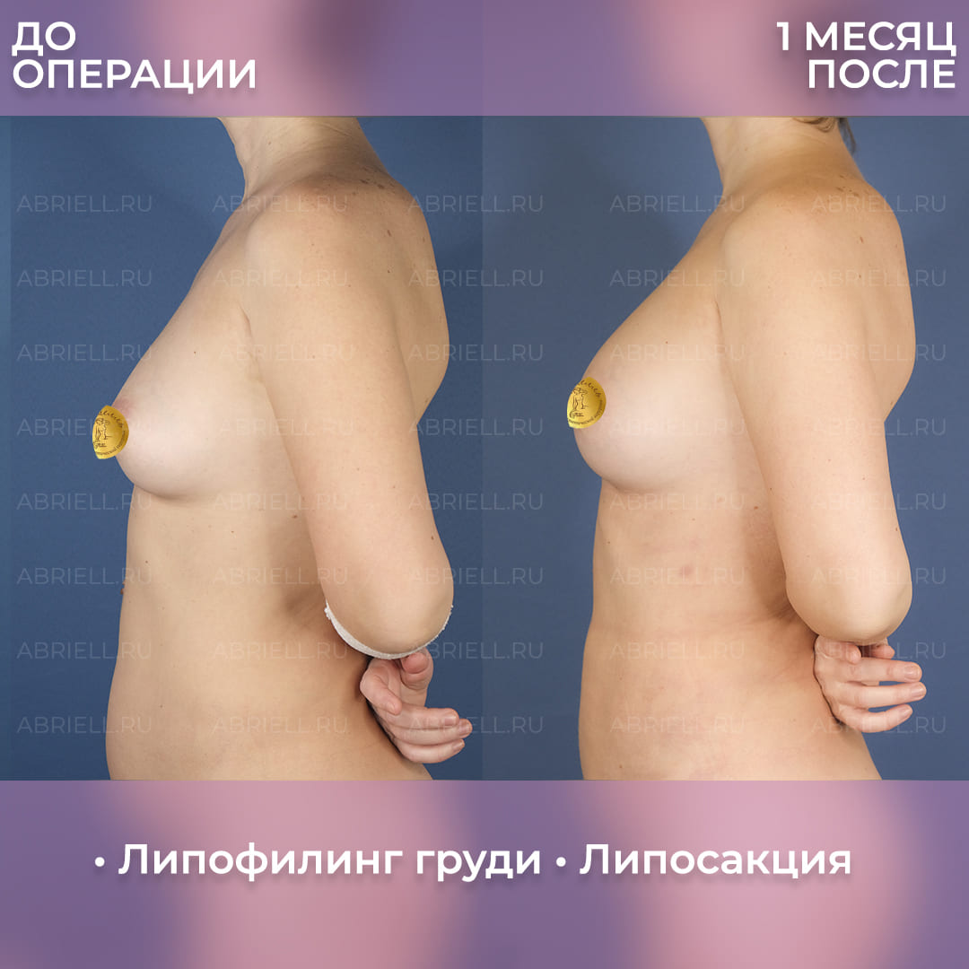 Фото результатов увеличения груди жиром