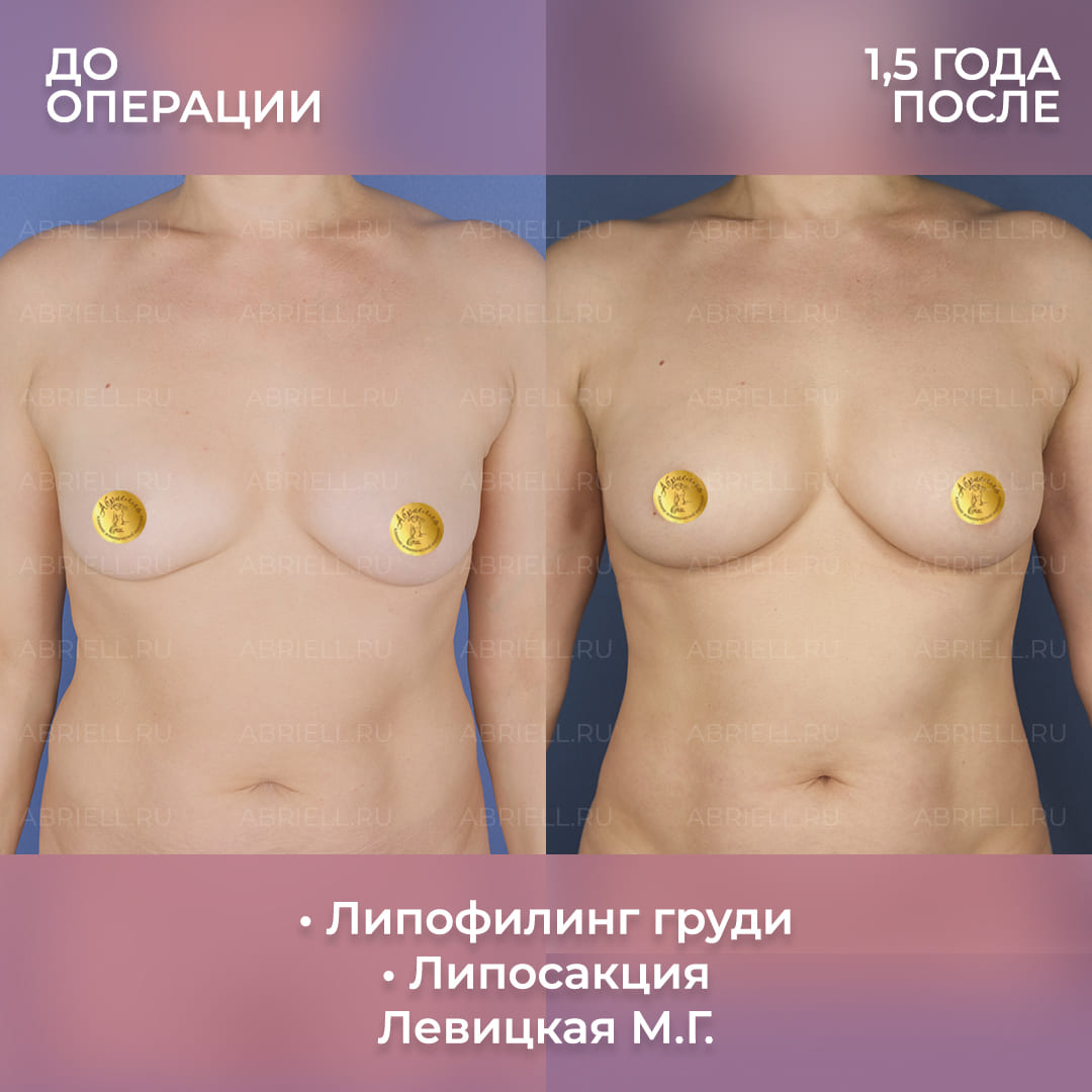 Результаты липофилинга груди