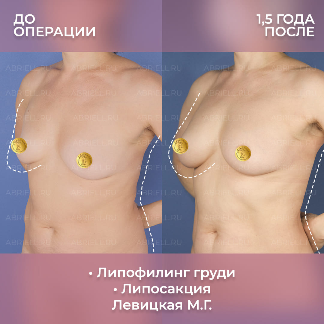 Фото с результатами липофилинга груди