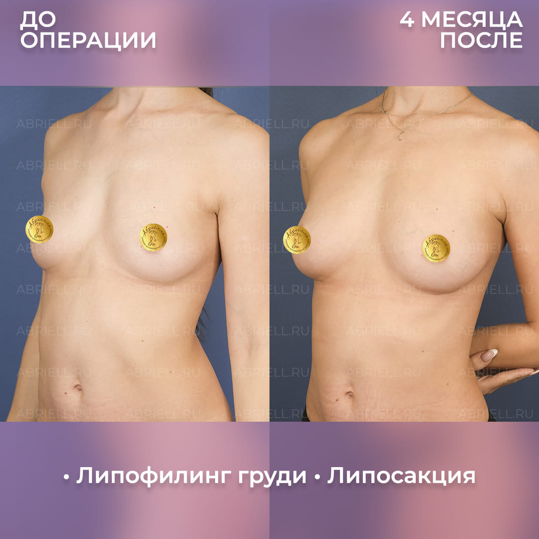 Результаты липофилинга груди с липосакцией