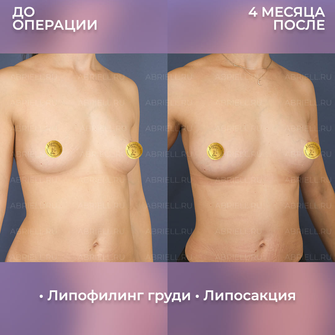 Фото результатов липофилинга груди с липосакцией