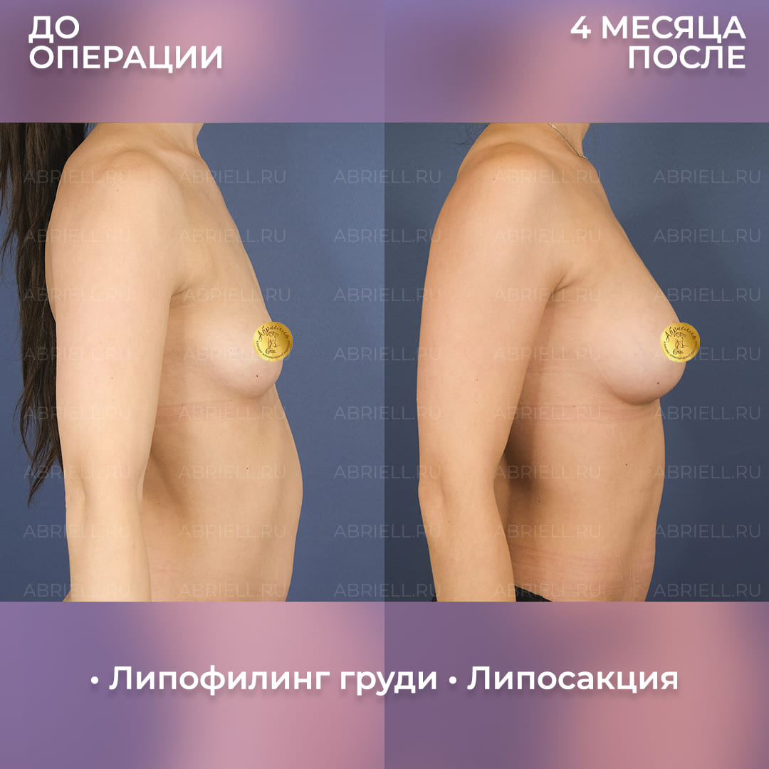 Последствия липофилинга груди с липосакцией