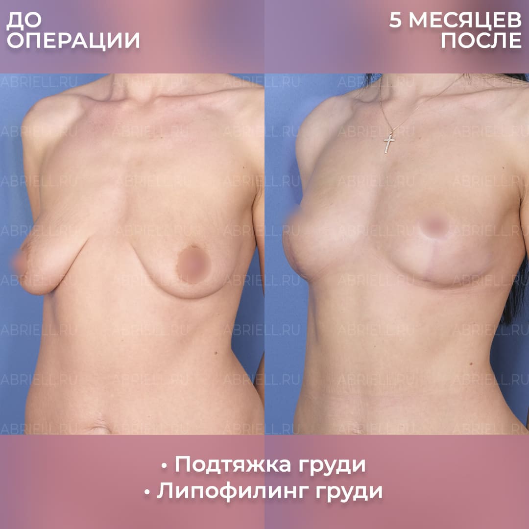 Результаты подтяжки груди