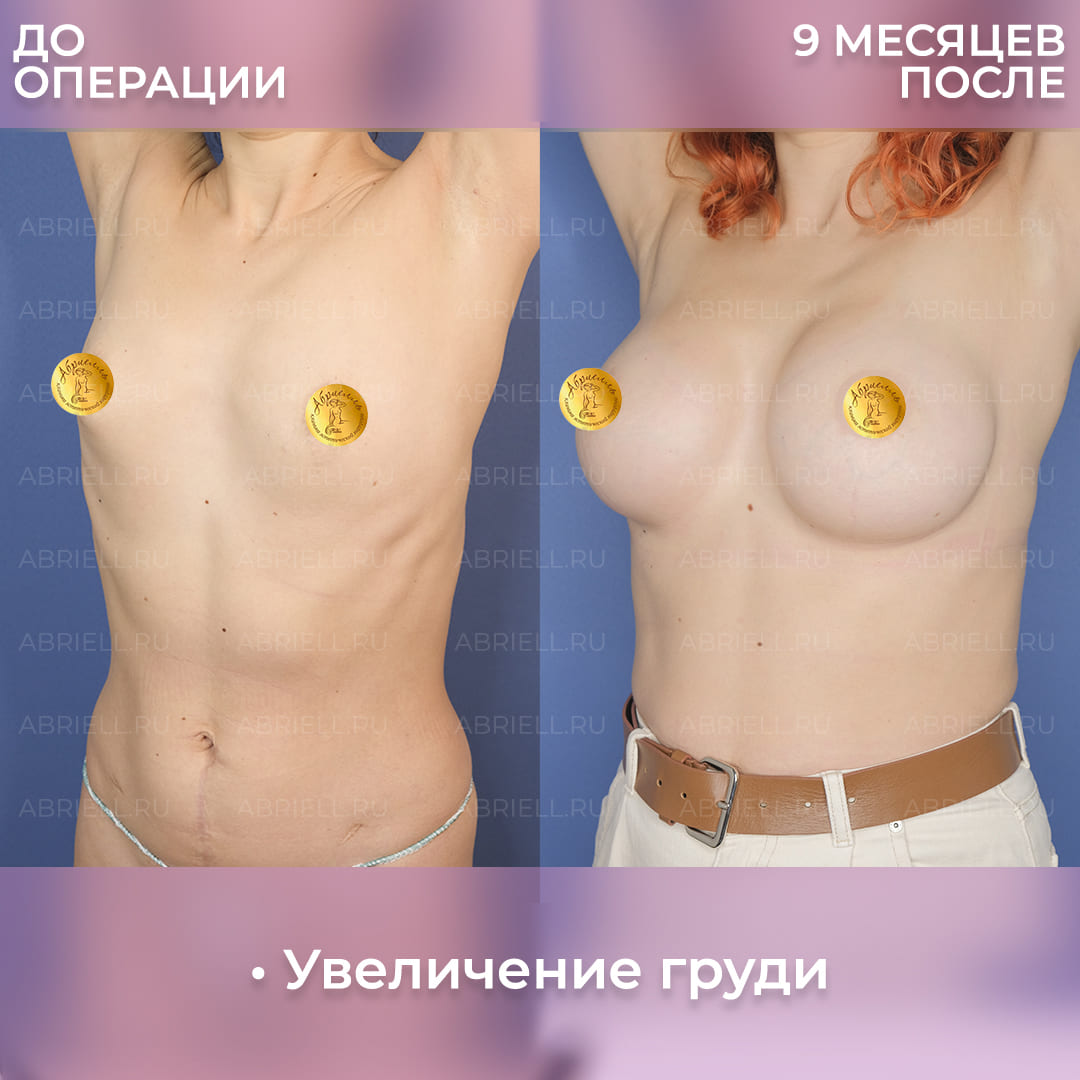Результаты увеличения груди