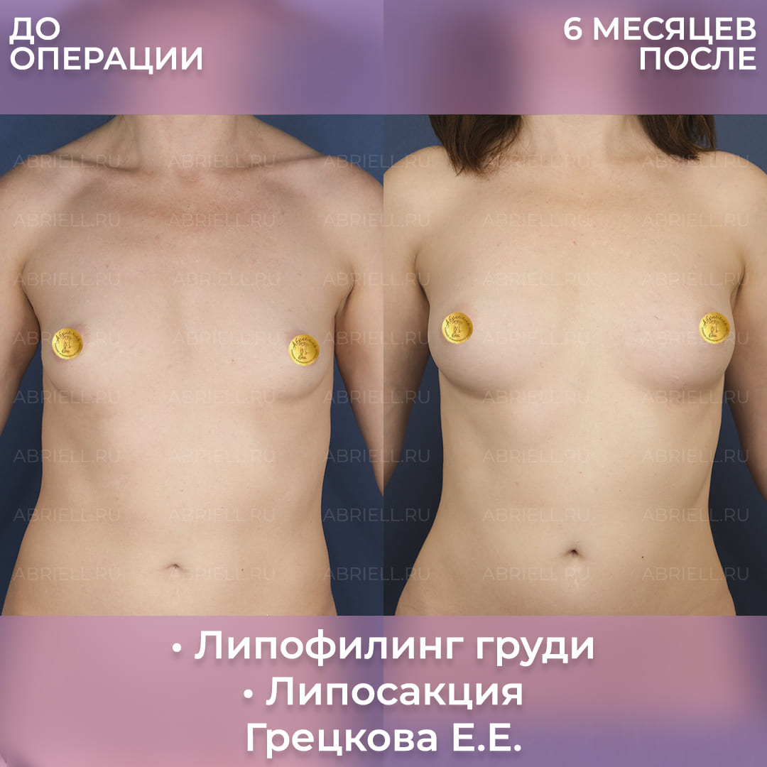 Результаты увеличения груди липофилингом
