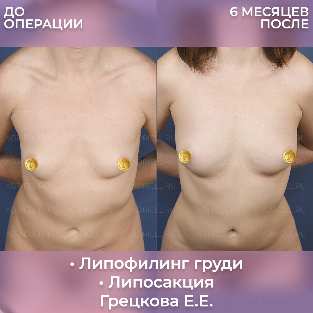 Фото после увеличения груди липофилингом