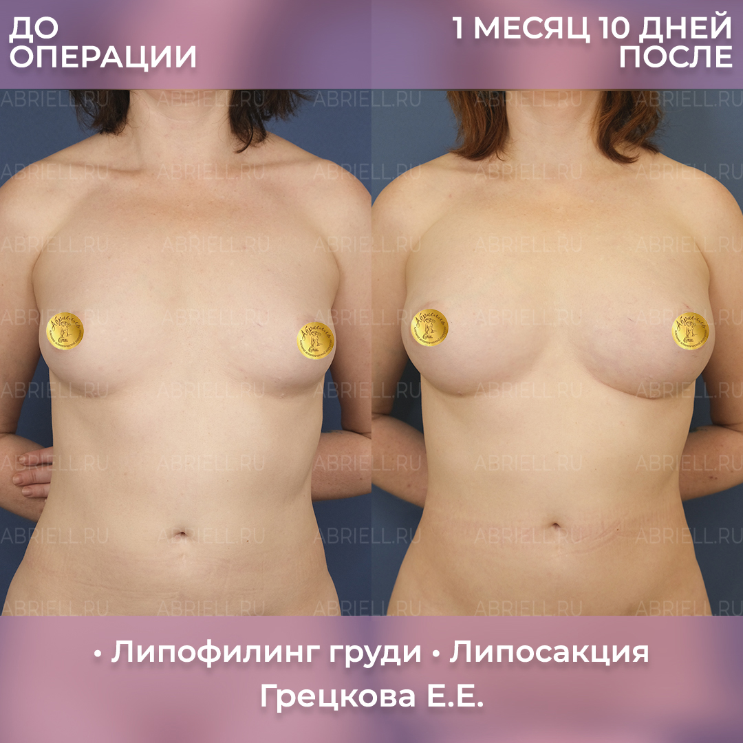 До и после увеличения груди липофилингом