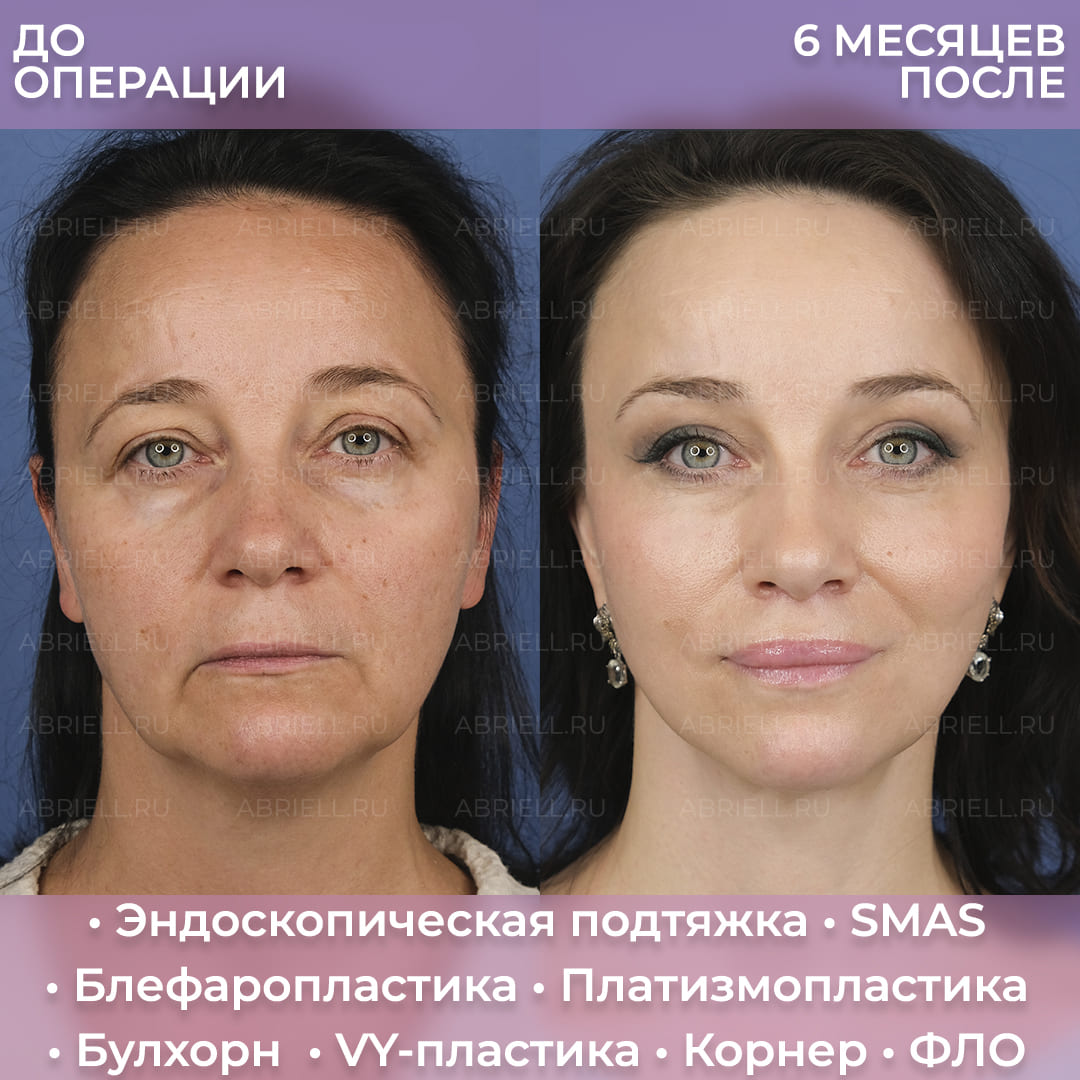 Фото до и после SMAS подтяжки лица