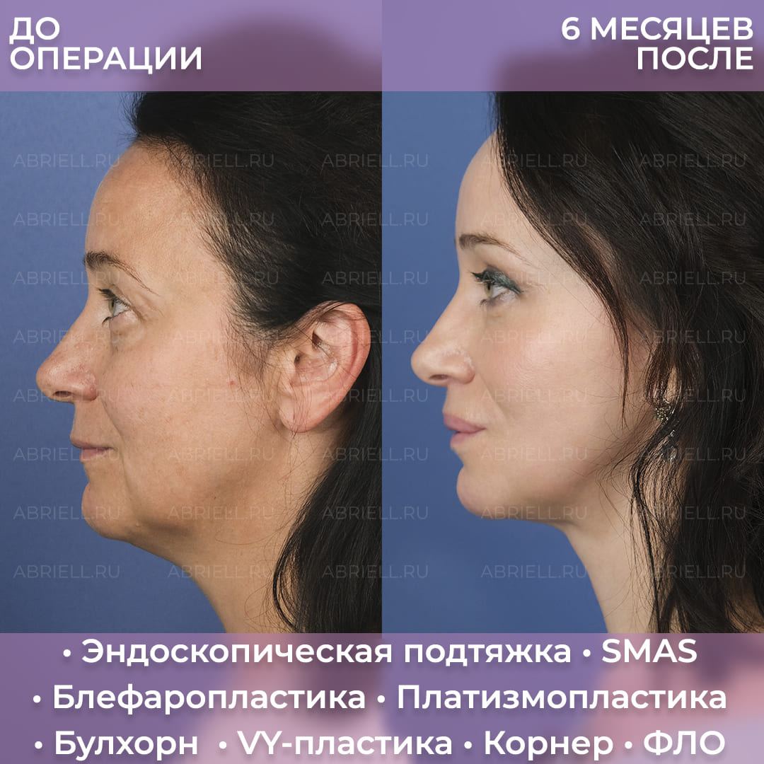 Фото до и после SMAS подтяжки лица