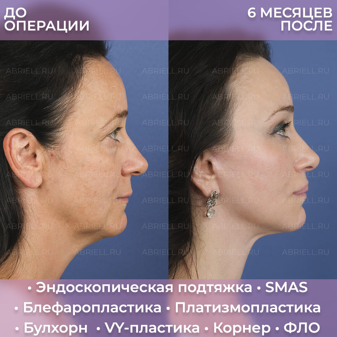 До и после SMAS лица