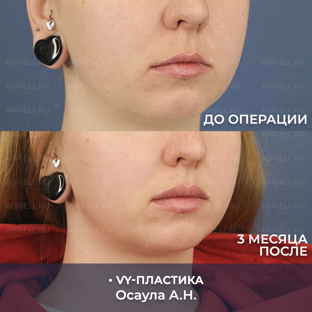 VY пластика результаты