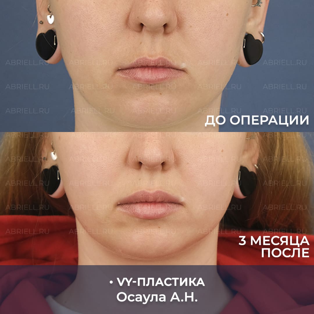 VY пластика результаты
