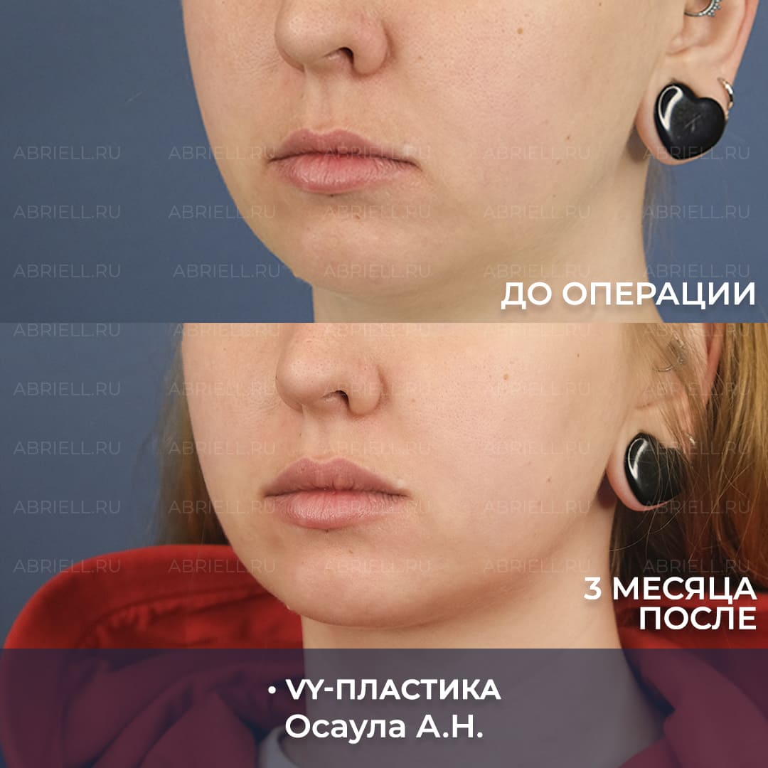 VY пластика результаты