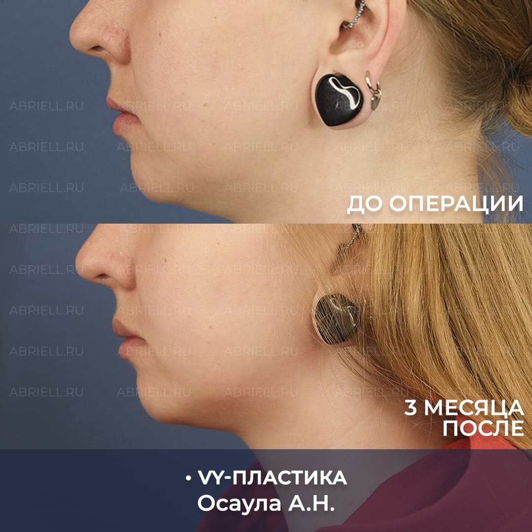 VY пластика результаты