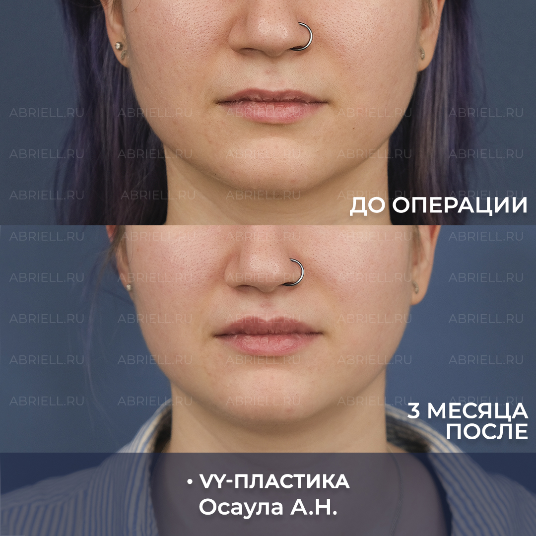 VY пластика результаты