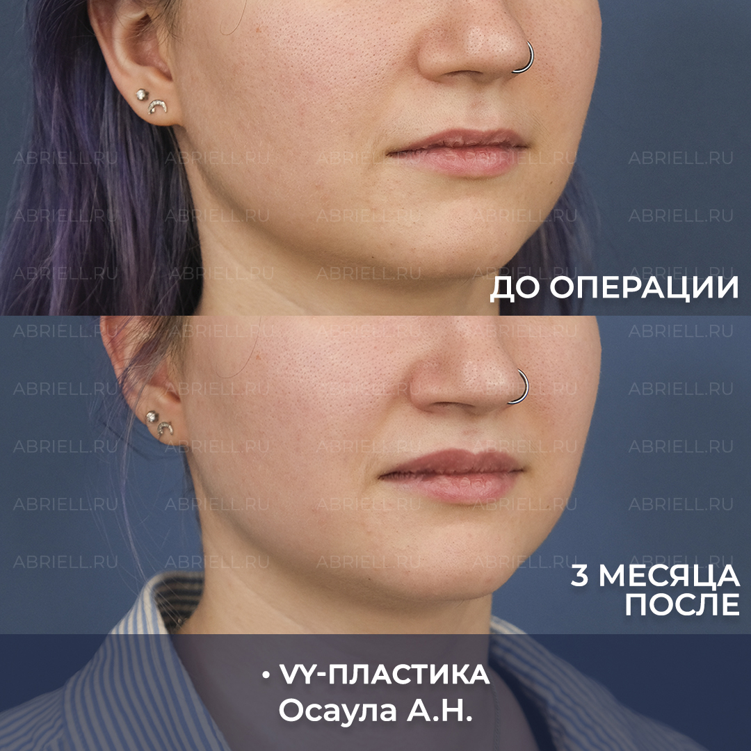 VY пластика результаты