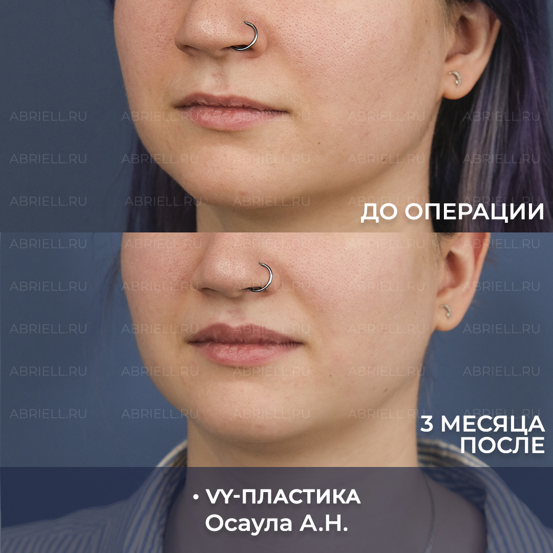 VY пластика результаты