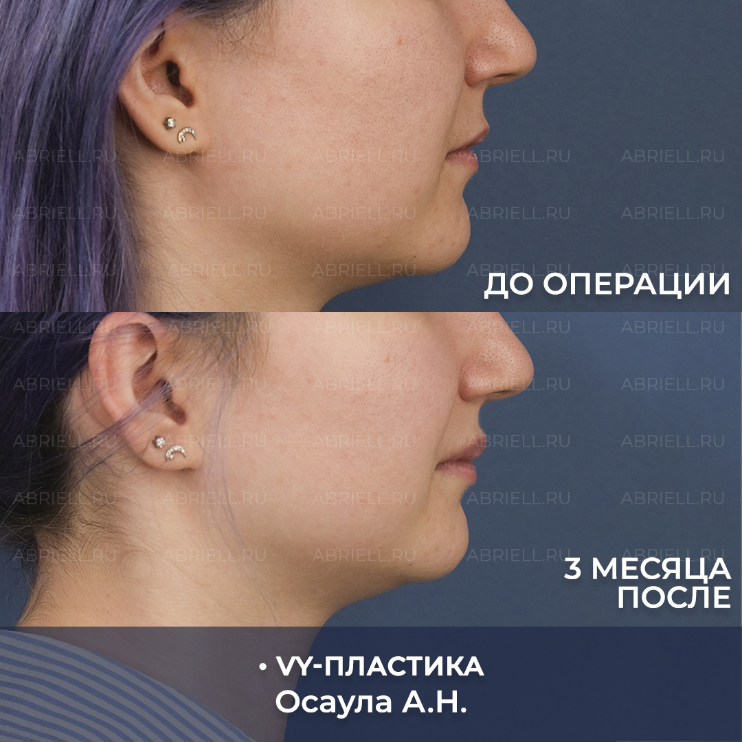 VY пластика результаты